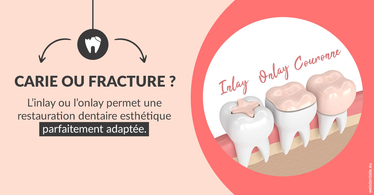 https://selarl-soliwil.chirurgiens-dentistes.fr/T2 2023 - Carie ou fracture 2