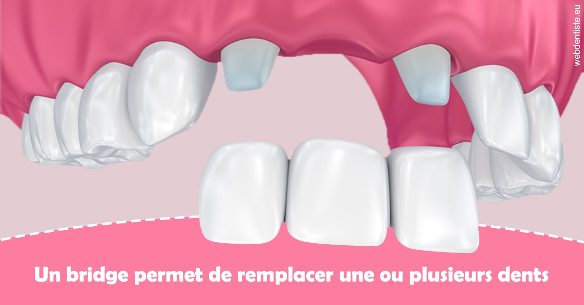 https://selarl-soliwil.chirurgiens-dentistes.fr/Bridge remplacer dents 2