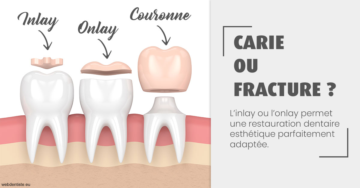 https://selarl-soliwil.chirurgiens-dentistes.fr/T2 2023 - Carie ou fracture 1