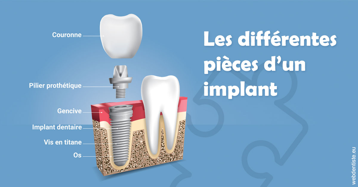 https://selarl-soliwil.chirurgiens-dentistes.fr/Les différentes pièces d’un implant 1